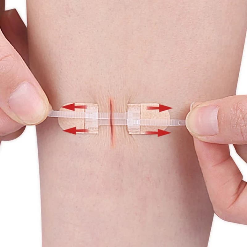 Dispositivo di Chiusura Ferite Senza Sutura con Cerniera, Strisce per Medicazione Ferite, Kit di Pronto Soccorso, Benda per Chiusura Lacerazioni d'Emergenza