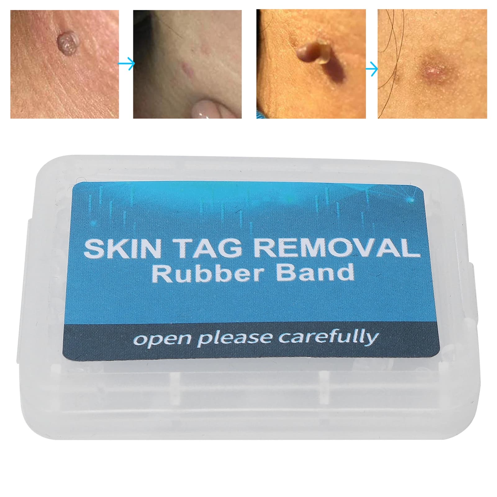 30Pcs Skin label removal kit painless removal of mole wart removal skin label treatment micro removal of black meat calli warts tool for care